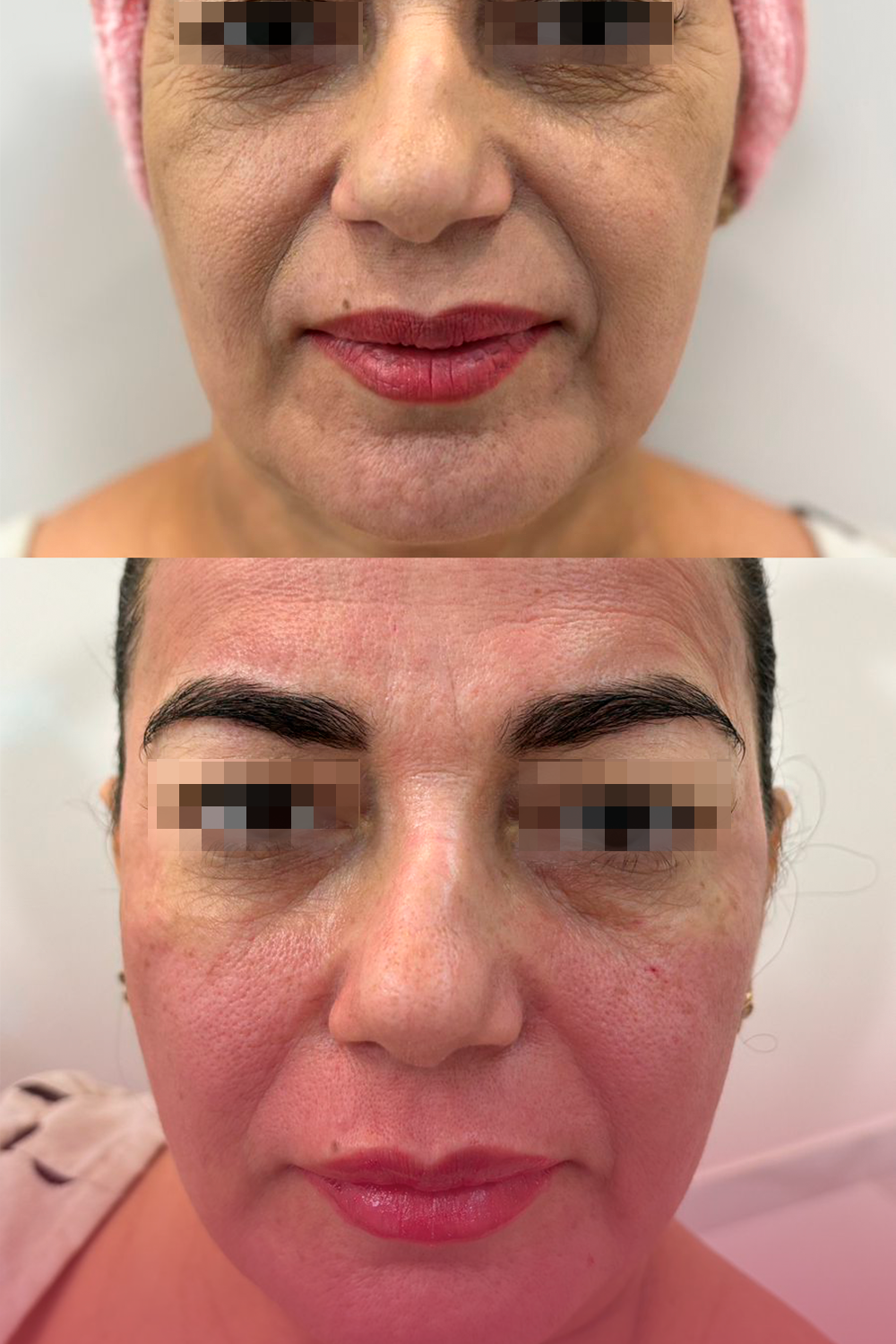foto harmonização facial
