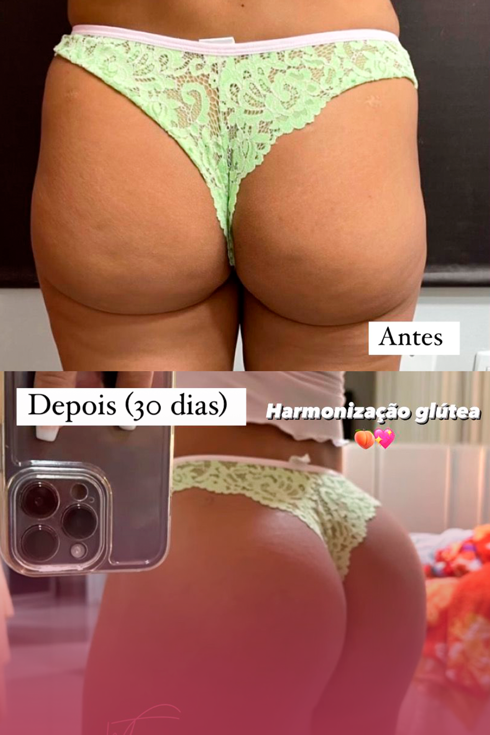 foto harmonização glútea